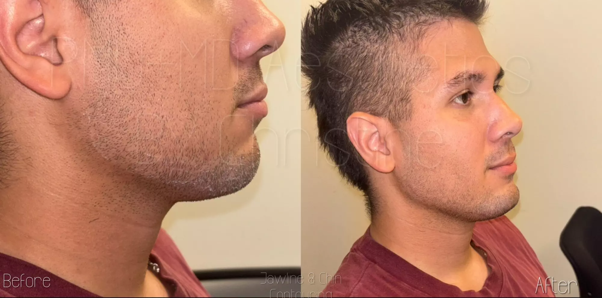Up to 43% Off on Juvederm Injection - at PMU MD Aesthetics