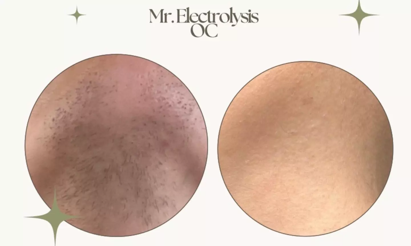 Up to 46% Off on Electrolysis at Mr. Electrolysis OC - Primary Image