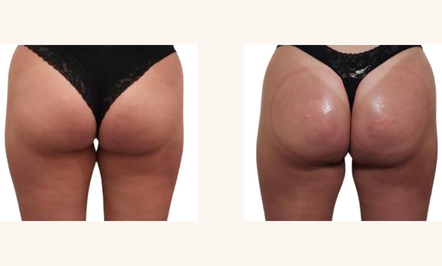 Image 3: Up to 47% Off on Non-Surgical Butt Lift