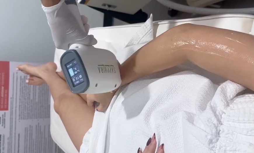 Image 2: Enjoy Six Sessions of Laser Hair Removal on Small or Large Areas