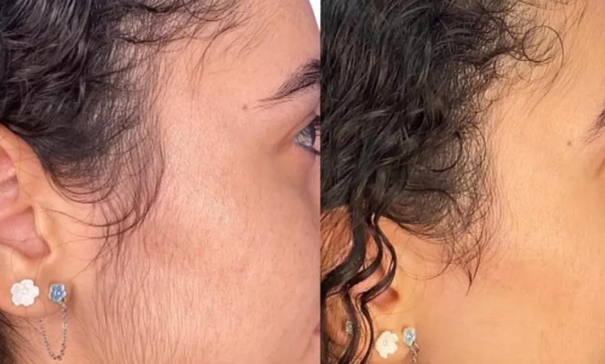 Image 7: Up to 95% Off Laser Hair Removal Icon MD Medical Spa Plus Laser Center