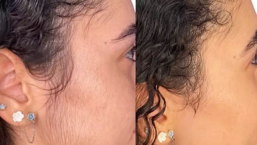 Up to 94% Off Laser Hair Removal Icon MD Medical Spa Plus Laser Center - Second Medium