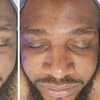 Image 4: Up to 31% Off on HydraFacial at Phoenix Esthetics of CT