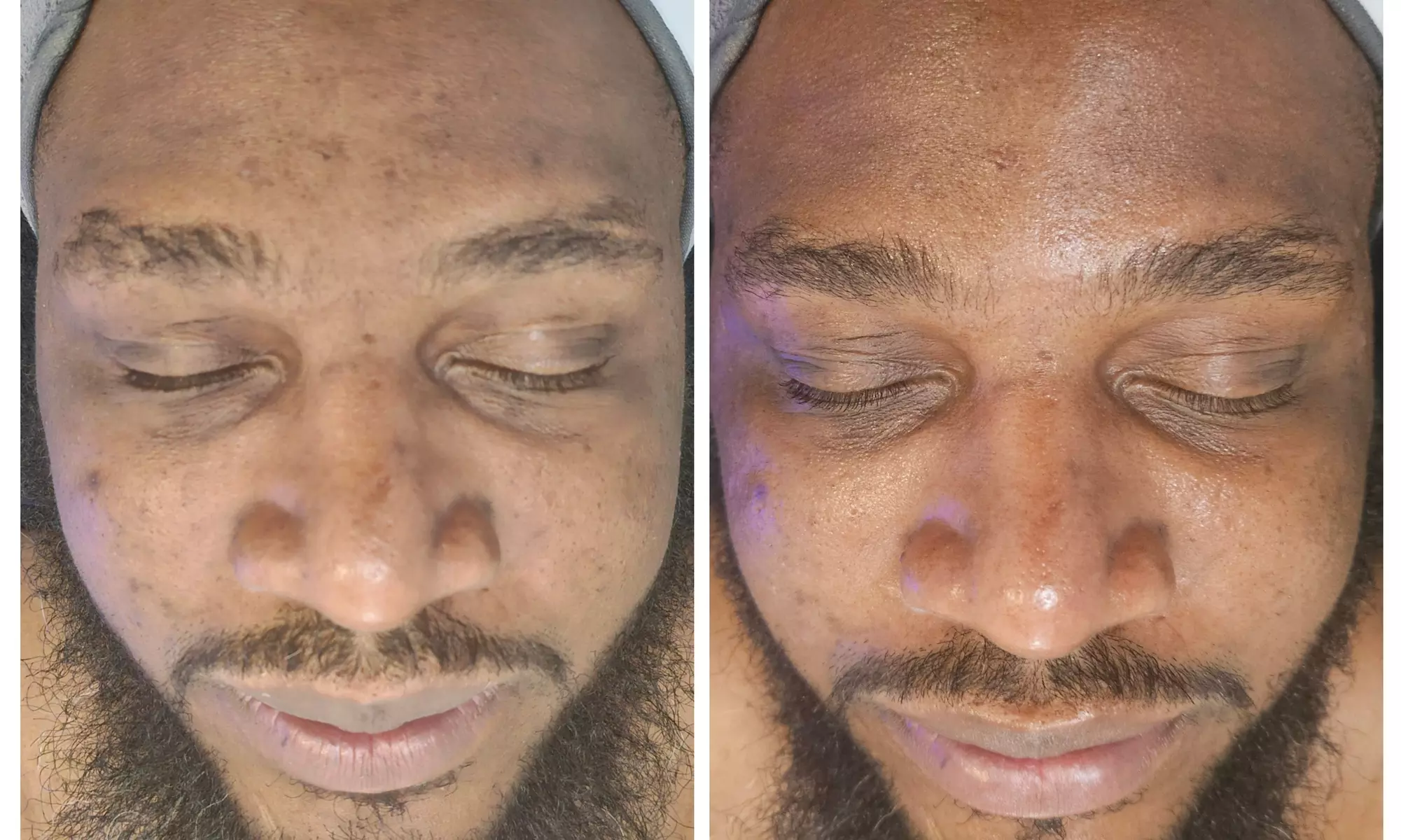 Up to 40% Off on HydraFacial at Phoenix Esthetics of CT