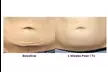 Experience Rewind Advanced Aesthetics'  Skin Tightening for Stomach, Eyes, Neck, or Knees (Up to 30% Off) - Second Medium