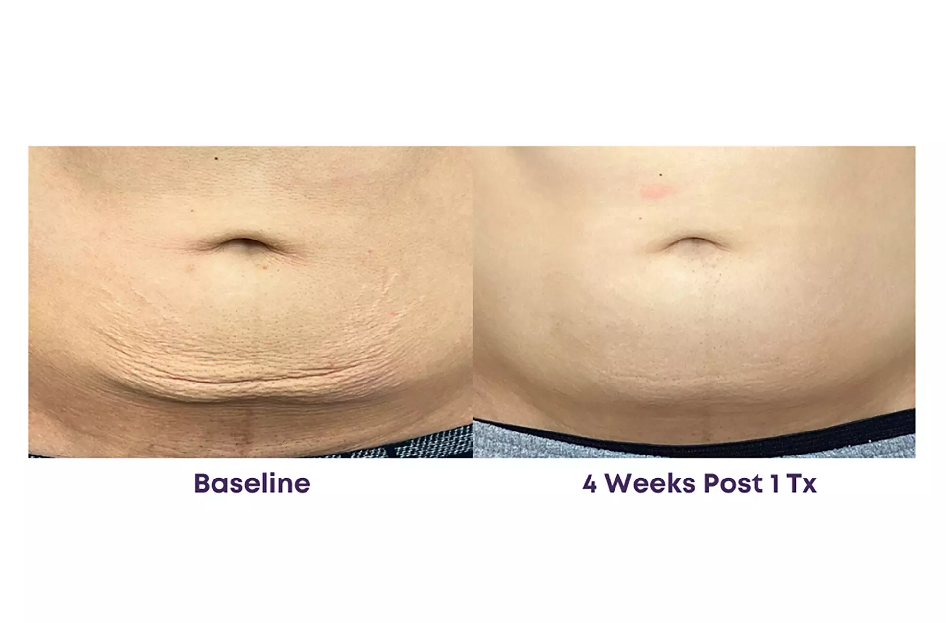 Experience Rewind Advanced Aesthetics'  Skin Tightening for Stomach, Eyes, Neck, or Knees (Up to 40% Off)
