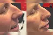 Up to 44% Off on Injection - Organic Filler at PMU + MD AESTHETICS - Second Medium