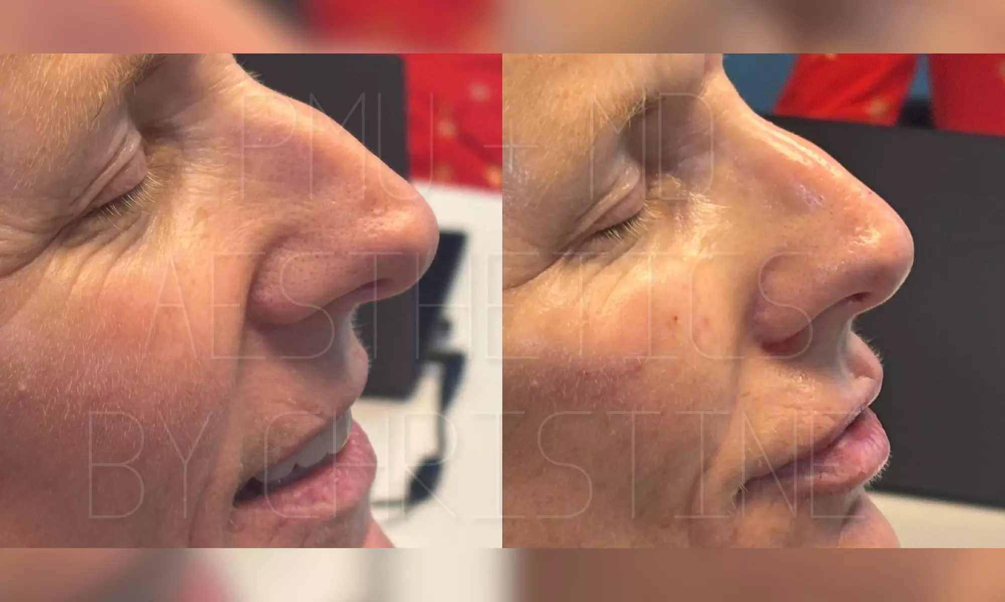 Up to 45% Off on Injection - Juvederm Filler 