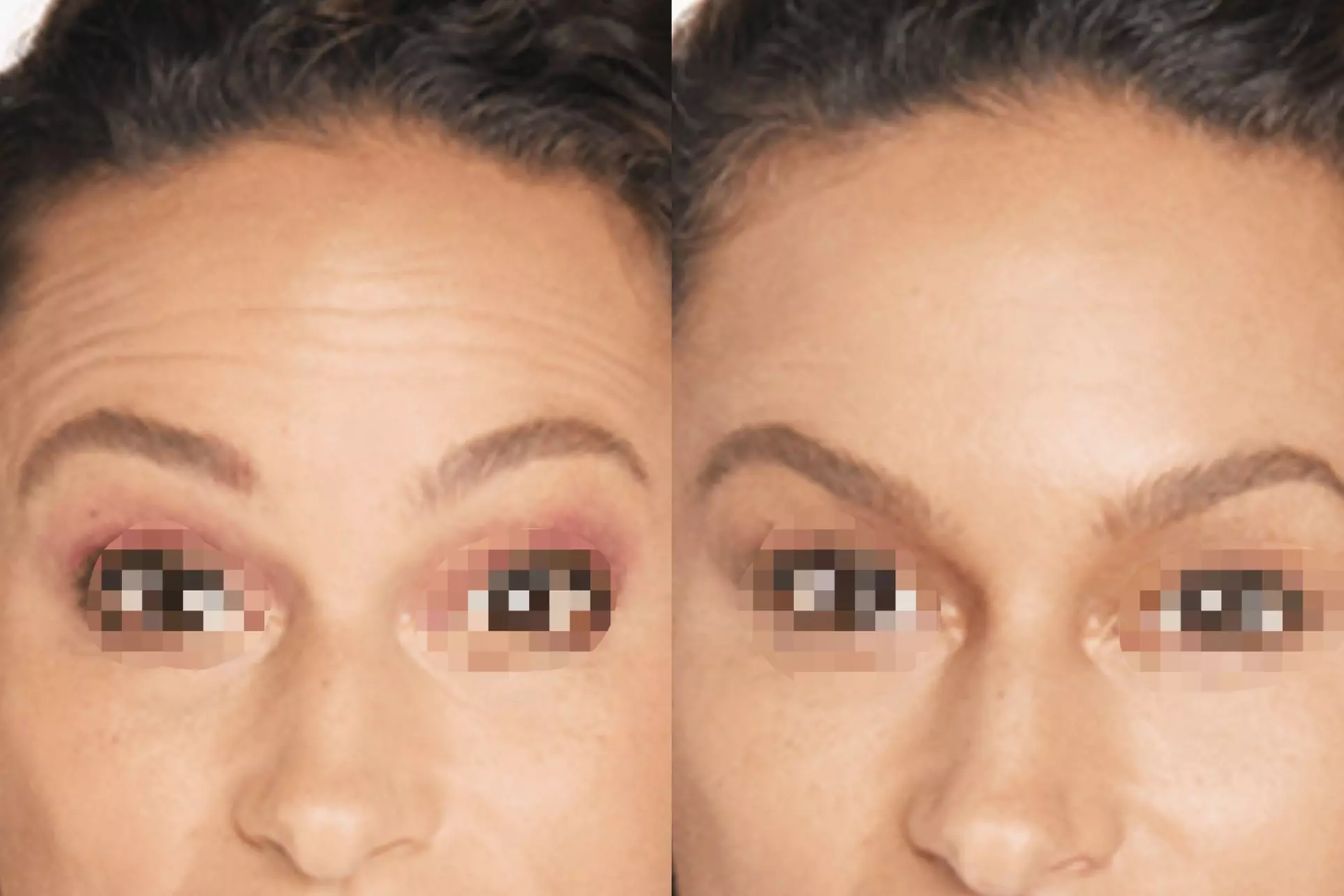 Achieve a Smooth, Youthful Look with Xeomin: 20 Units