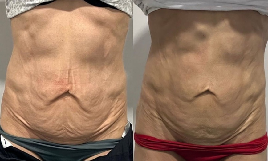 Image 3: Up to 57% Off on Ultrasonic Fat Reduction at ILLUME Skin Spa