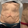 Image 3: Up to 61% Off on Ultrasonic Fat Reduction at ILLUME Skin Spa