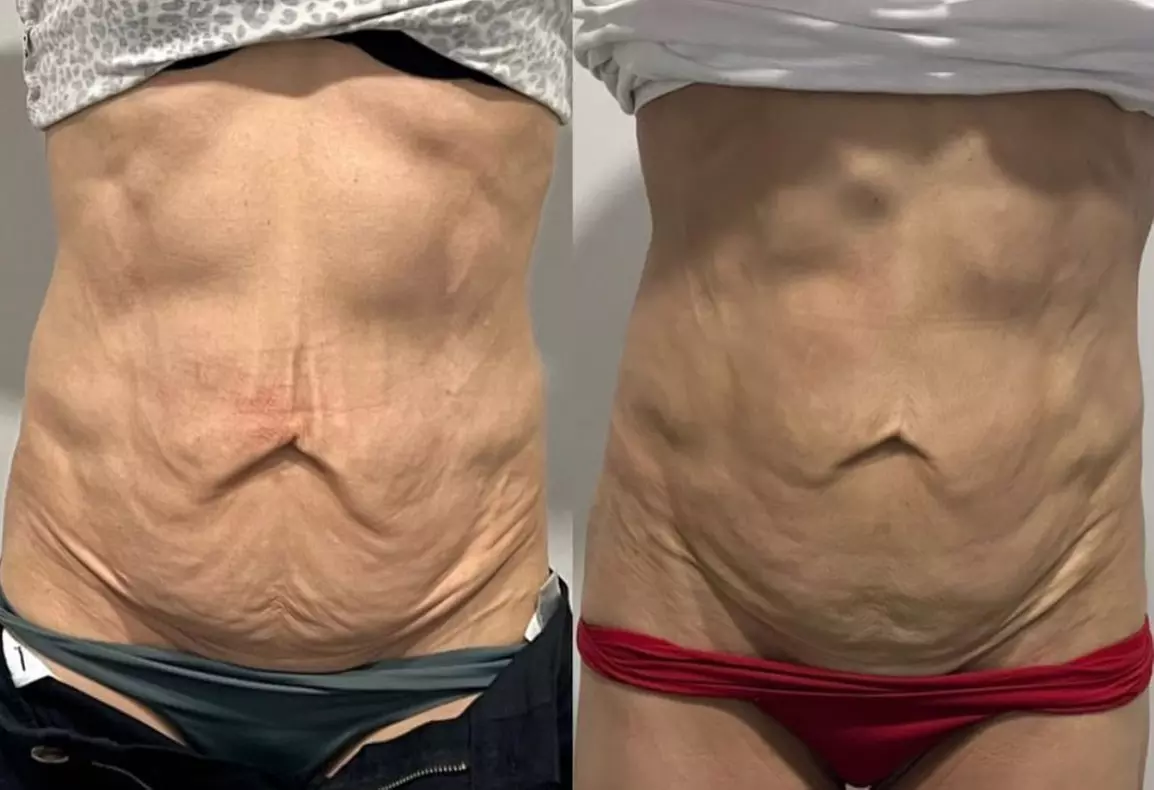 Up to 57% Off on Ultrasonic Fat Reduction at ILLUME Skin Spa