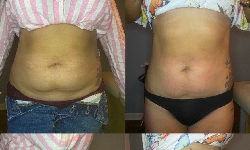 Image 1: Single Session of BodyFX or MiniFX Fat Reduction and Skin Tightening