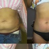 Image 1: Single Session of BodyFX or MiniFX Fat Reduction and Skin Tightening