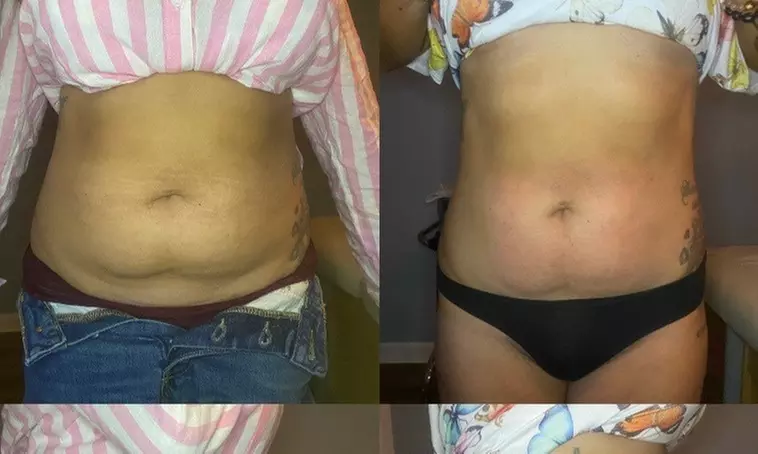 Single Session of BodyFX or MiniFX Fat Reduction and Skin Tightening