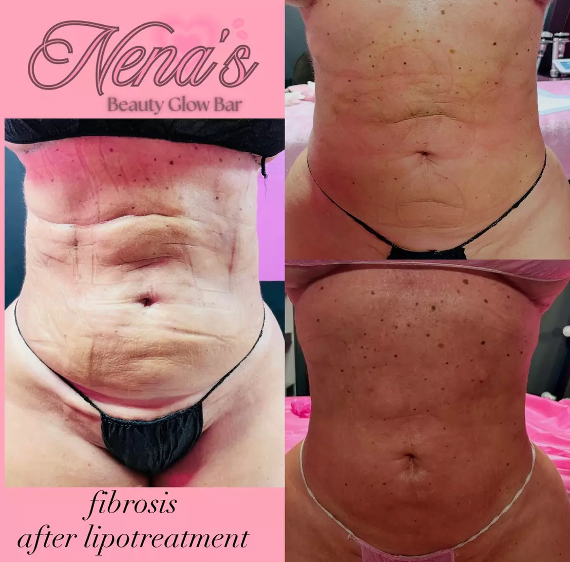 Embrace a comprehensive Post-op care (after lipo/ bbl/ tummy tucks)