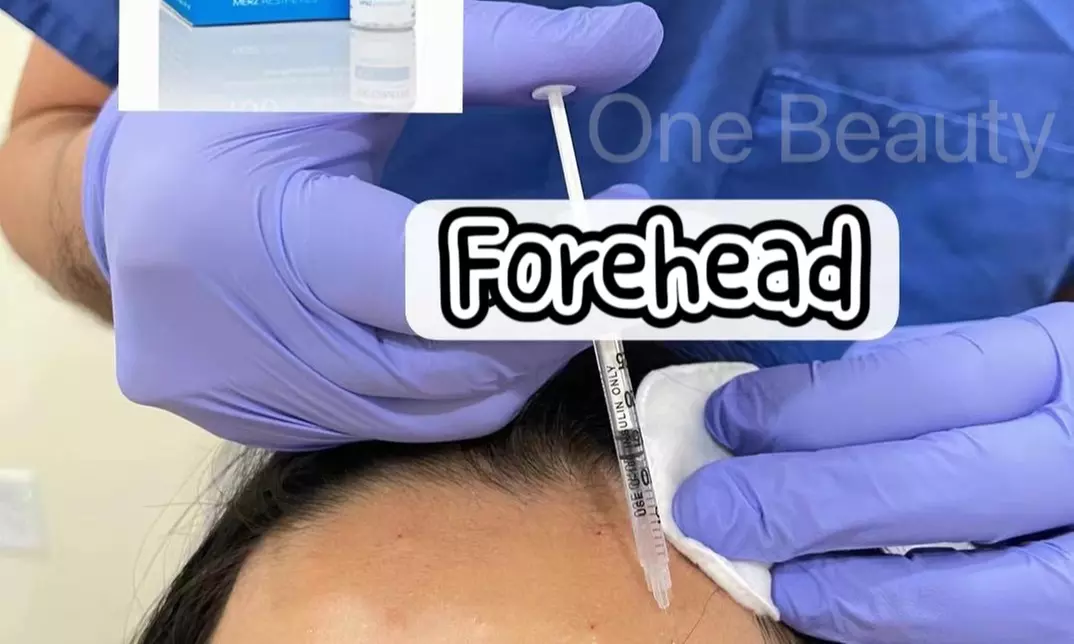 Up to 48% Off on Injection-Other-Dysport, Xeomin at One Beauty Aesthetics - Second Medium