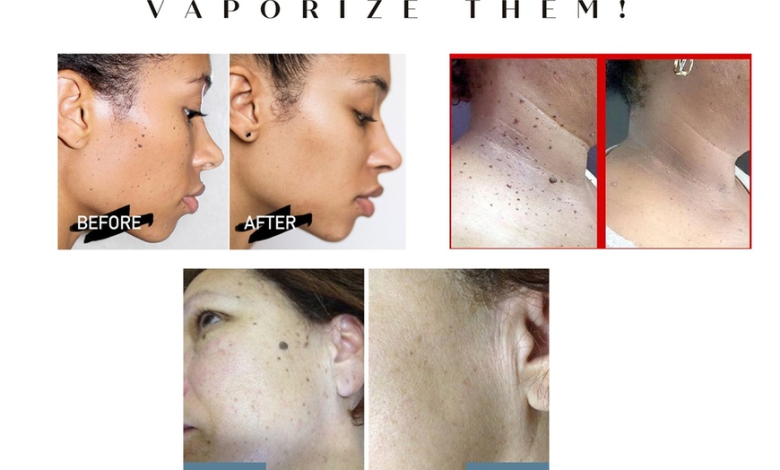 Image 3: Get Face, Neck, or Chest Lamprobe Treatment