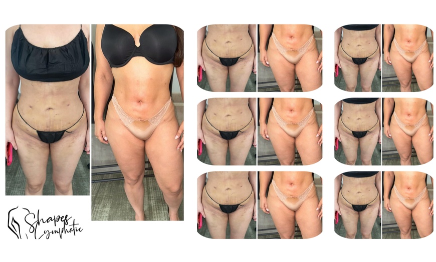 Image 1: Up to 25% Off on Lymphatic Drainage Massage at Shapes Lymphatic