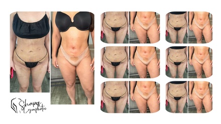 One 60 mins Lymphatic or Post-Op Massage - Shapes Lymphatic