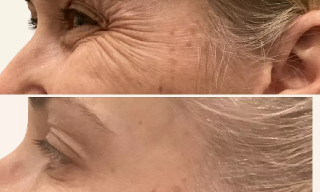 Smooth Your Skin with 20, 40 or 60 Units of Xeomin Injections