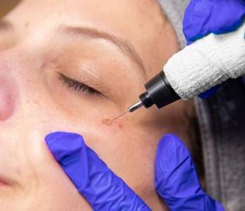 Sesión de plasma pen para eliminar verrugas y queratosis - Tellamor Clinic