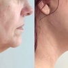 Image 3: Up to 60% Off on Facelift - Non-Surgical at NY Esthetics Clinic