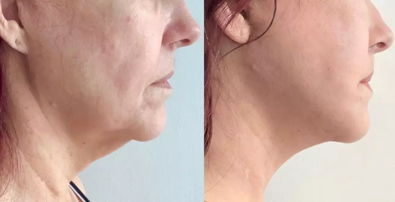 Up to 55% Off on Facelift - Non-Surgical at NY Esthetics Clinic