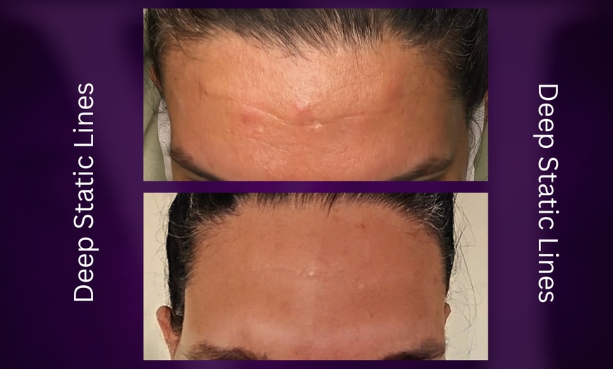 Image 9: Azzalure Skin Booster for Target Frown, Forehead & Eye Wrinkles 