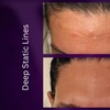 Image 9: Azzalure Skin Booster for Target Frown, Forehead & Eye Wrinkles 