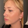 Image 1: Refresh Your Appearance with 20, 40, or 60 Units of Botox