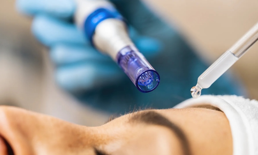 Image 4: Refresh your skin w/ 1 or 3 Micro-Needling Hyaluronic Acid Treatment 