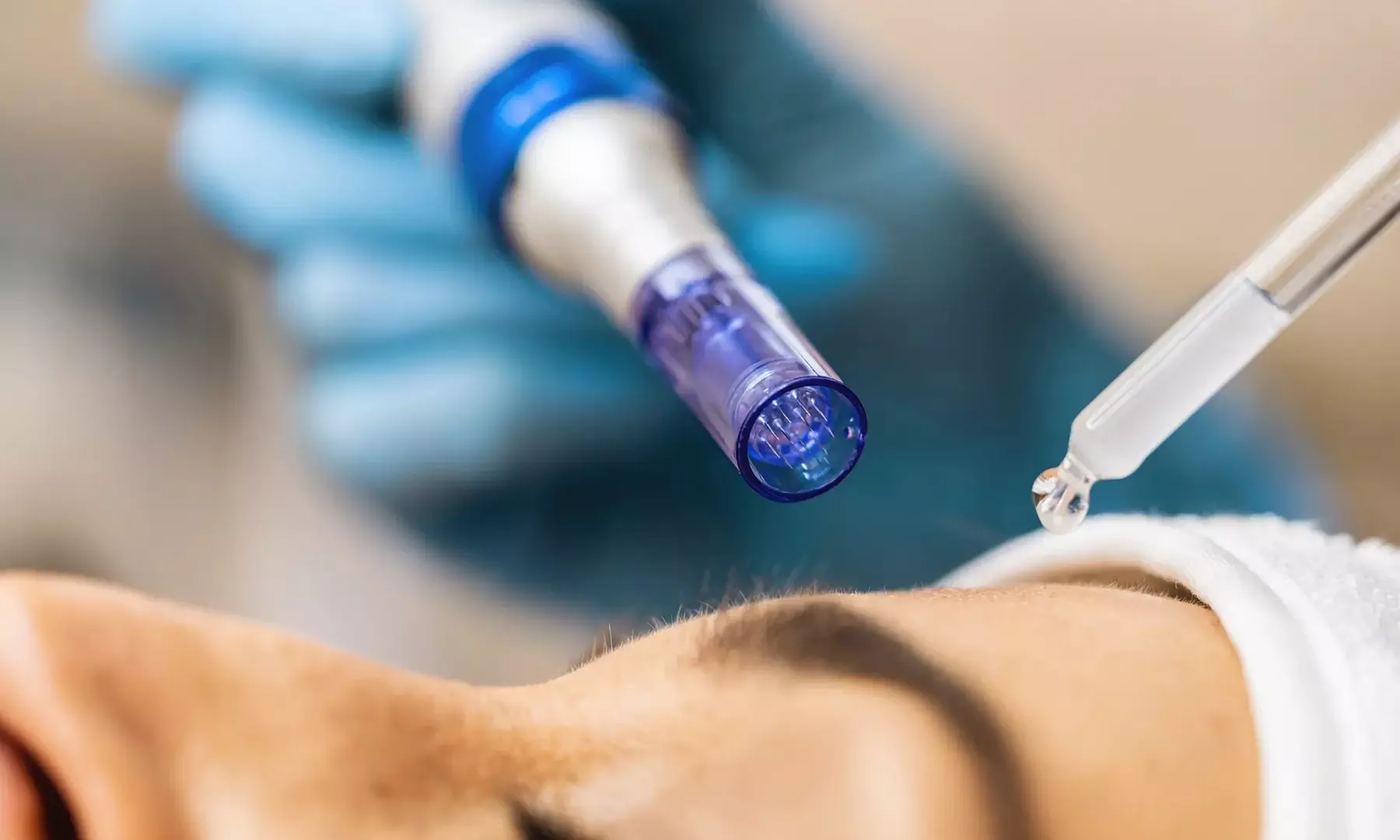 Refresh your skin with 1 or 3 Micro-Needling Hyaluronic Acid Treatment at VVS Permanent Beauty - Up to 50% Off - Second Medium
