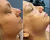 Experience One or Two ADVATx Laser Lip Plump + Opt Skin-Resurfacing Facial @Moi Health & Wellness(Up To 40% Off)