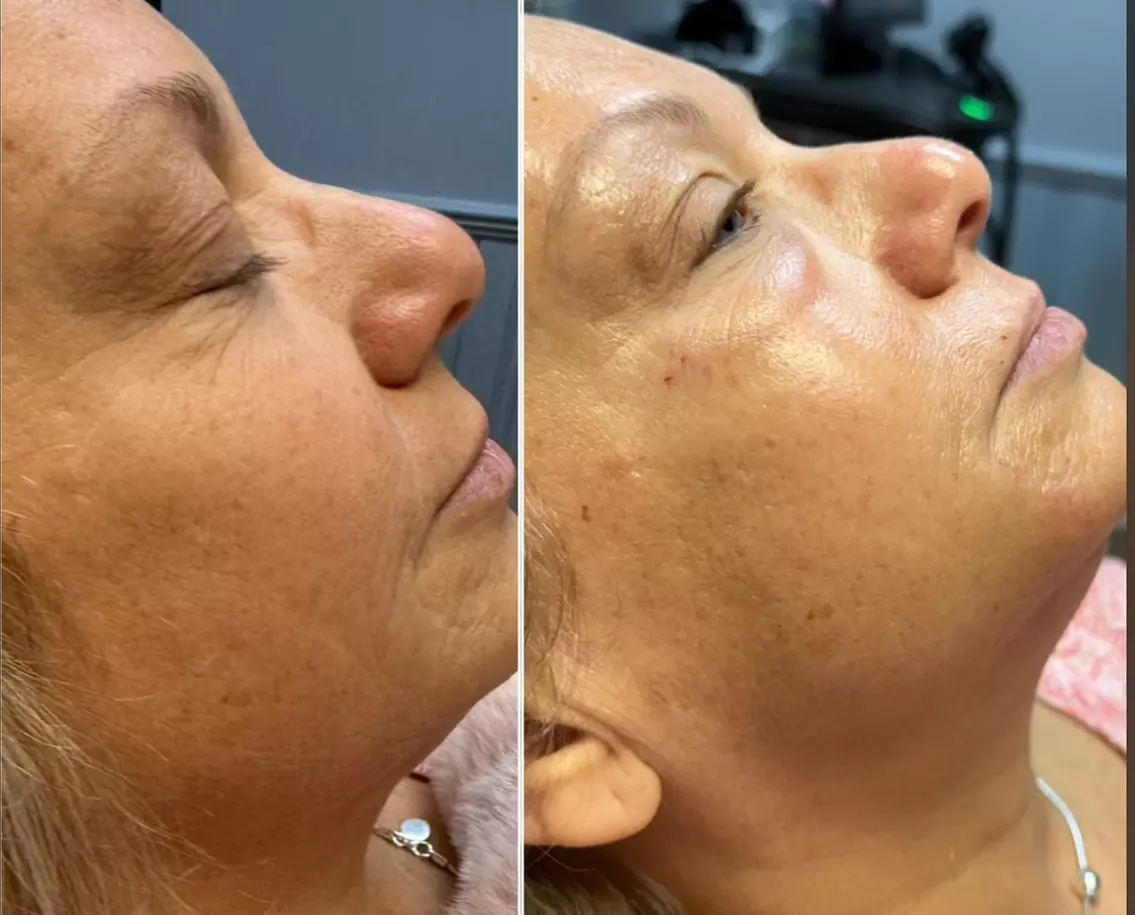 Experience One or Two ADVATx Laser Lip Plump + Opt Skin-Resurfacing Facial @Moi Health & Wellness(Up To 40% Off) - Primary Image