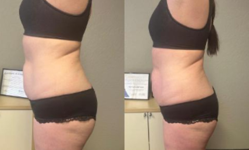 Image 4: Ultrasonic Cavitation Body Contouring with 1 3 6 or 9 Sessions 
