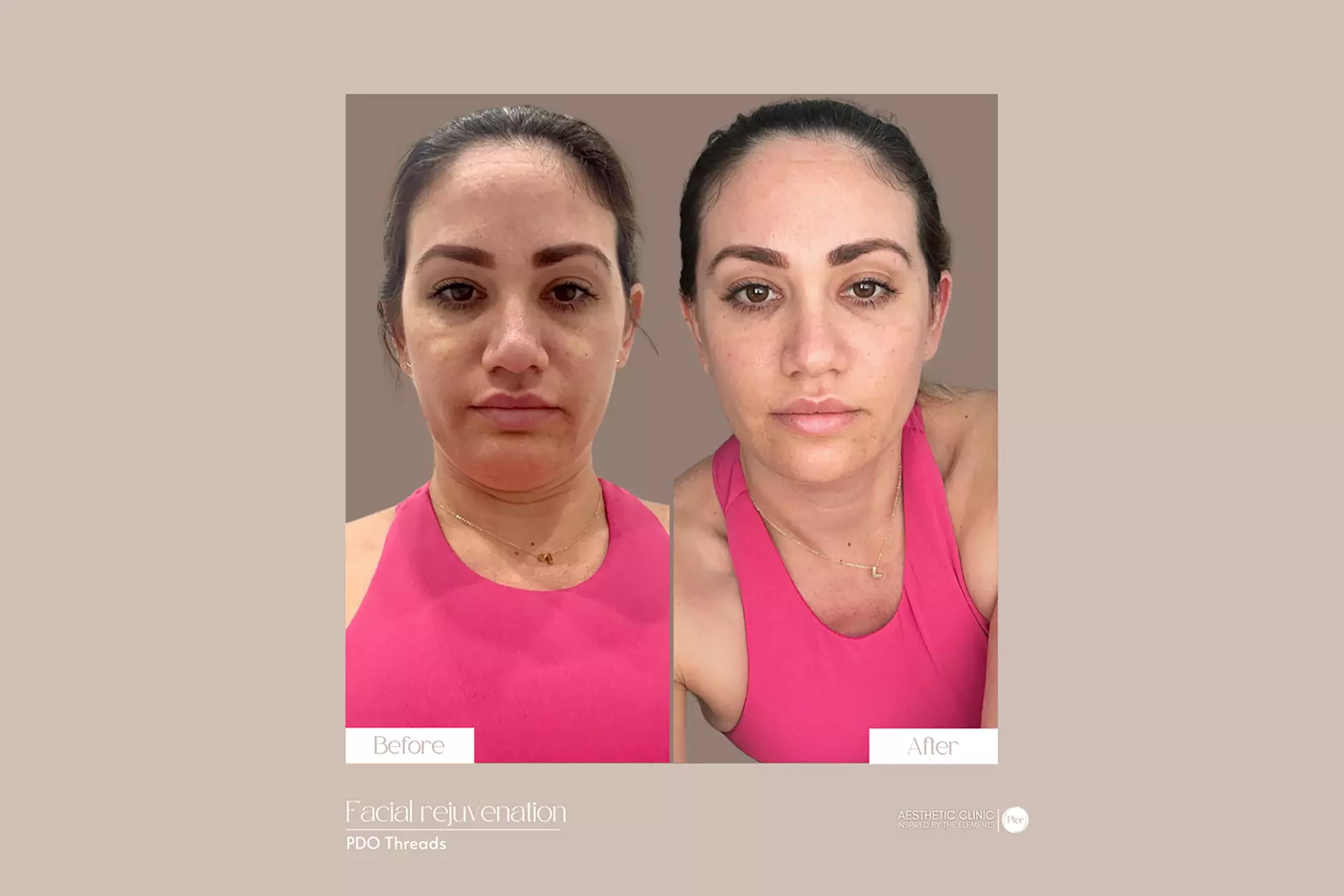 Smooth, Youthful Skin Awaits: 20 or 40 Units of Botox at Pler Miami