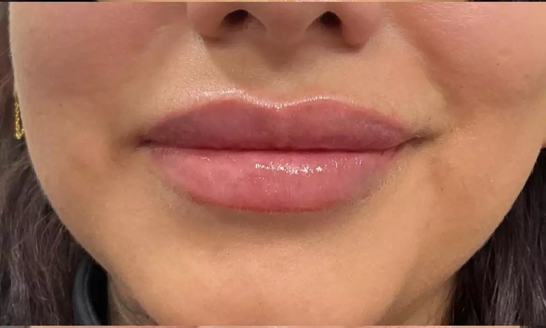 Revitalize Your Features with Daxxify Brow Lift, Lip Flip, Lip Filler, or More (Up To 61% Off) - Primary Image