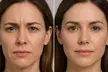 Up to 46% Off on Juvederm Injection - at PMU MD Aesthetics (Virtual Consultation Required) - Second Medium