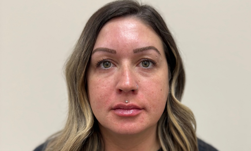 Image 6: Botox 20 - 40 units Lip Filler One Syringe