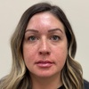 Image 6: Botox 20 - 40 units Lip Filler One Syringe