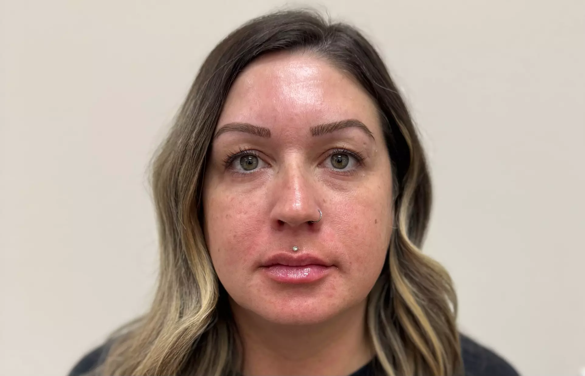 Botox Units (20–40) & Combo/Optional Lip Filler Syringe Injectables