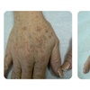 Image 4: Laser Skin Rejuvenation for Face, Neck, or Hands