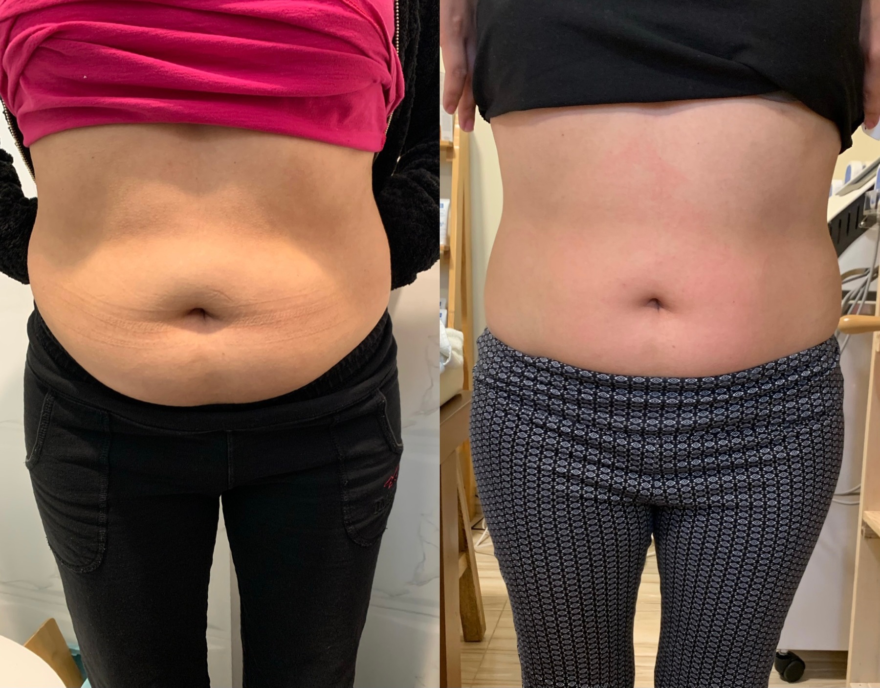 Experience One, Two or Three Cavitation Sessions With RF and EMS