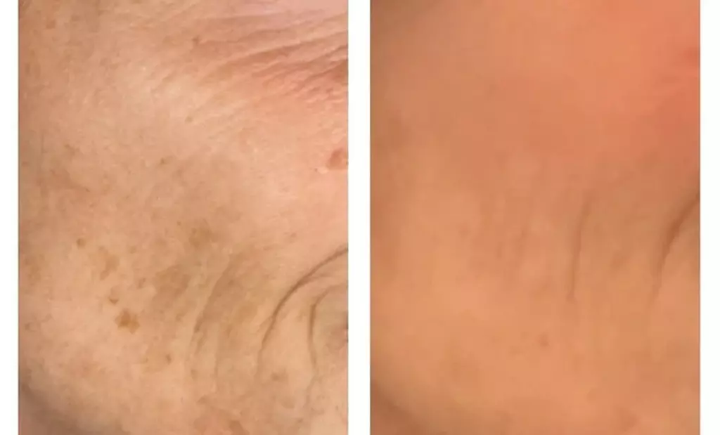 Revitalize Your Skin with 30 or 60-Minute Chemical Peels