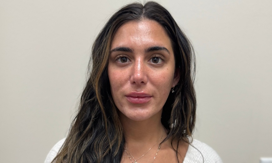 Image 4: Botox 20 - 40 units Lip Filler One Syringe