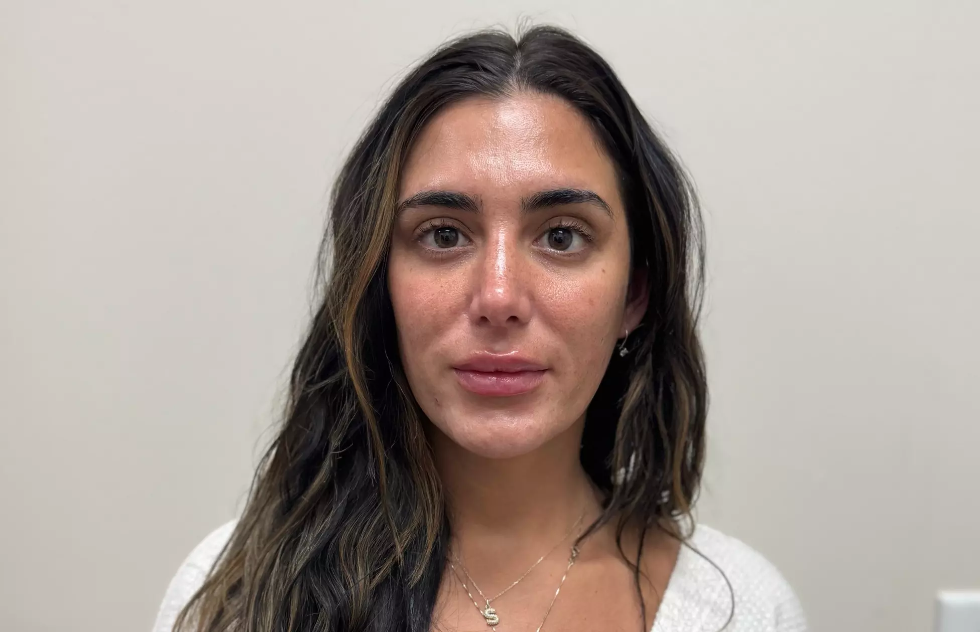 Botox Units (20–40) & Combo/Optional Lip Filler Syringe Injectables