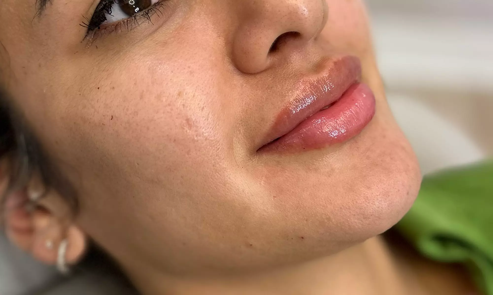 20, 40 or 60 Units of Botox or 1 ML Syringe Versa