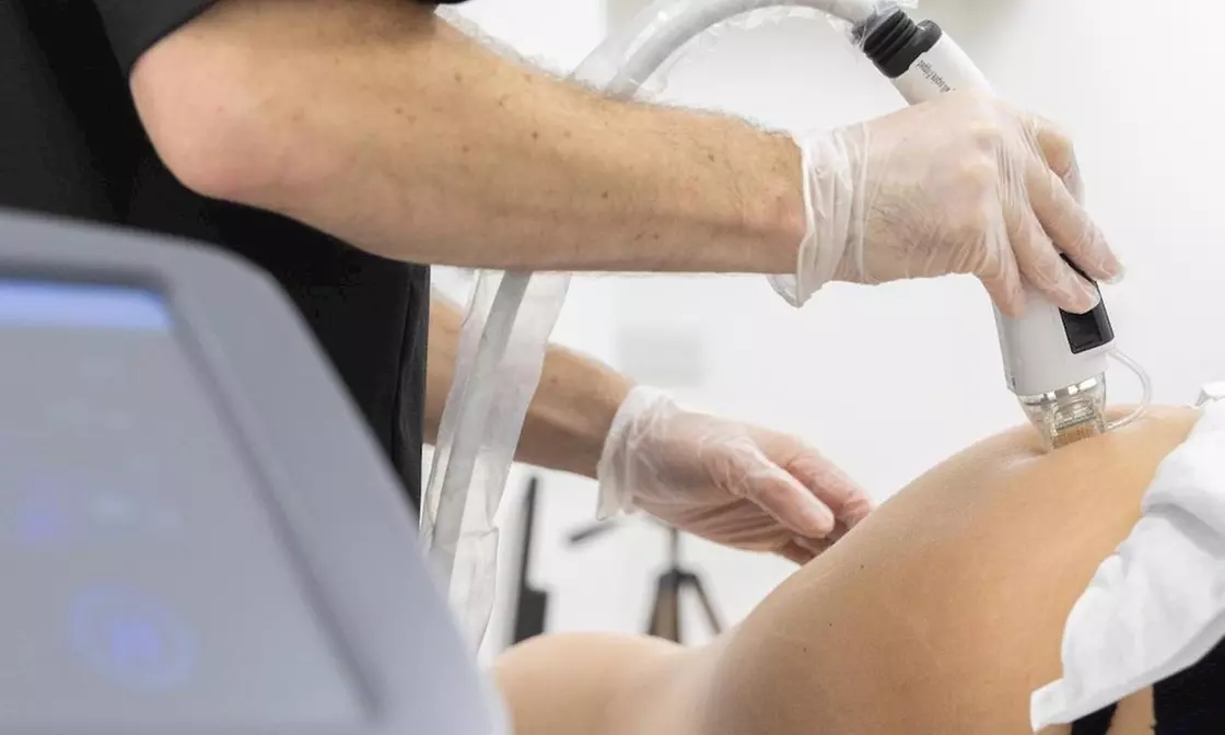 Body Confidence Boost: Tighten & Tone with Up to 60% Off RF Microneedling Treatments at SimplyBare Beauty! - Primary Image