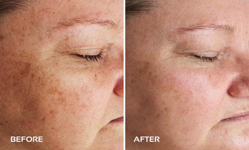 Image 4: Achieve Radiance with 6, 10, or 20 Dermalux MD Triwave LED Therapy 
